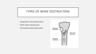 TYPES OF BONE DESTRUCTION
• Geographic Bone Destruction
• Moth-eaten Appearance
• Permeative Bone Destruction
 