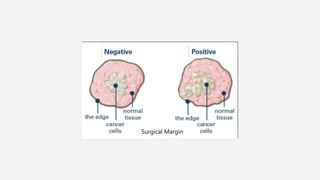 Surgical Margin
 
