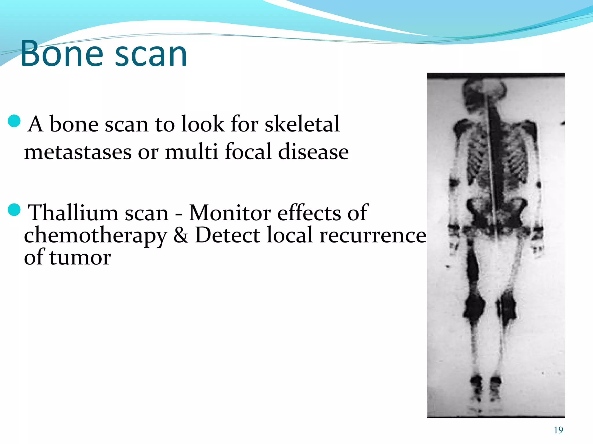Osteosarcoma ppt | PPT