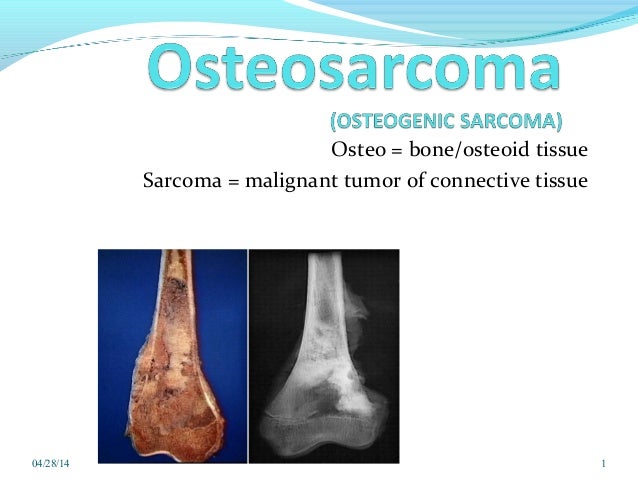 Osteosarcoma Ppt