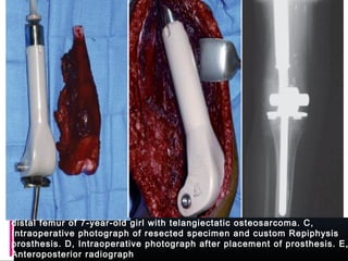 distal femur of 7-year-old girl with telangiectatic osteosarcoma. C,
Intraoperative photograph of resected specimen and custom Repiphysis
prosthesis. D, Intraoperative photograph after placement of prosthesis. E,
Anteroposterior radiograph
 