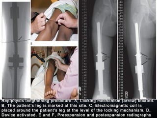 Repiphysis lengthening procedure. A, Locking mechanism (arrow) located.
B, The patient's leg is marked at this site. C, Electromagnetic coil is
placed around the patient's leg at the level of the locking mechanism. D,
Device activated. E and F, Preexpansion and postexpansion radiographs
 
