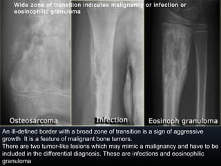 Wide zone of transition indicates malignancy or infection or
eosinophilic granuloma
An ill-defined border with a broad zone of transition is a sign of aggressive
growth It is a feature of malignant bone tumors.
There are two tumor-like lesions which may mimic a malignancy and have to be
included in the differential diagnosis. These are infections and eosinophilic
granuloma
 