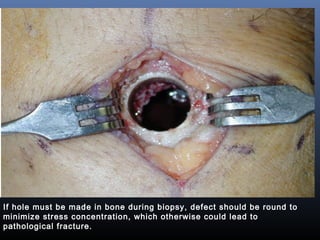 If hole must be made in bone during biopsy, defect should be round to
minimize stress concentration, which otherwise could lead to
pathological fracture.
 