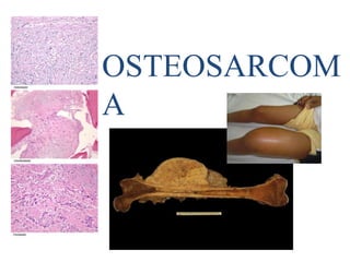 OSTEOSARCOM
A
 