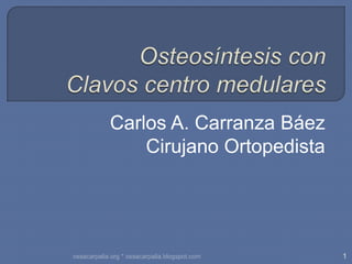 Osteosíntesis con Clavos centro medulares Carlos A. Carranza Báez Cirujano Ortopedista 1 ossacarpalia.org * ossacarpalia.blogspot.com 