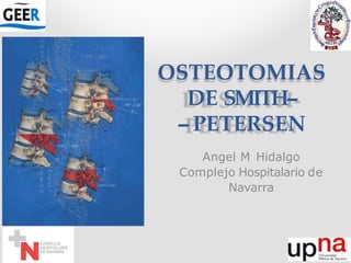 OSTEOTOMIAS
DE SMITH--
‐- PETERSEN
Angel M Hidalgo
Complejo Hospitalario de
Navarra
 