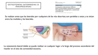 Comprehensive Overview of Nasal Osteotomies in Rhinoplasty: Techniques ...