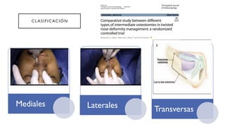 Comprehensive Overview of Nasal Osteotomies in Rhinoplasty: Techniques ...