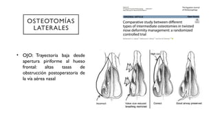Comprehensive Overview of Nasal Osteotomies in Rhinoplasty: Techniques ...