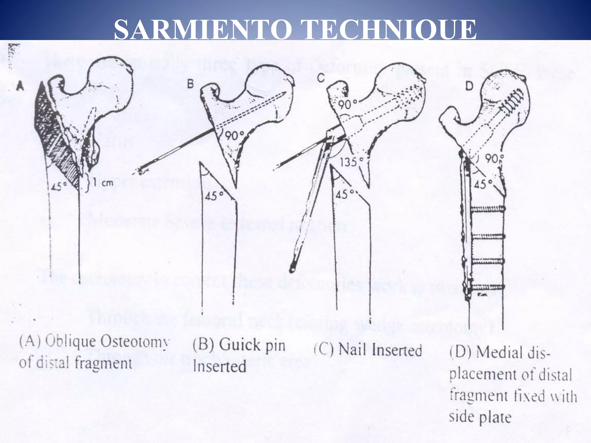 Osteotomies around the hip | PPTX