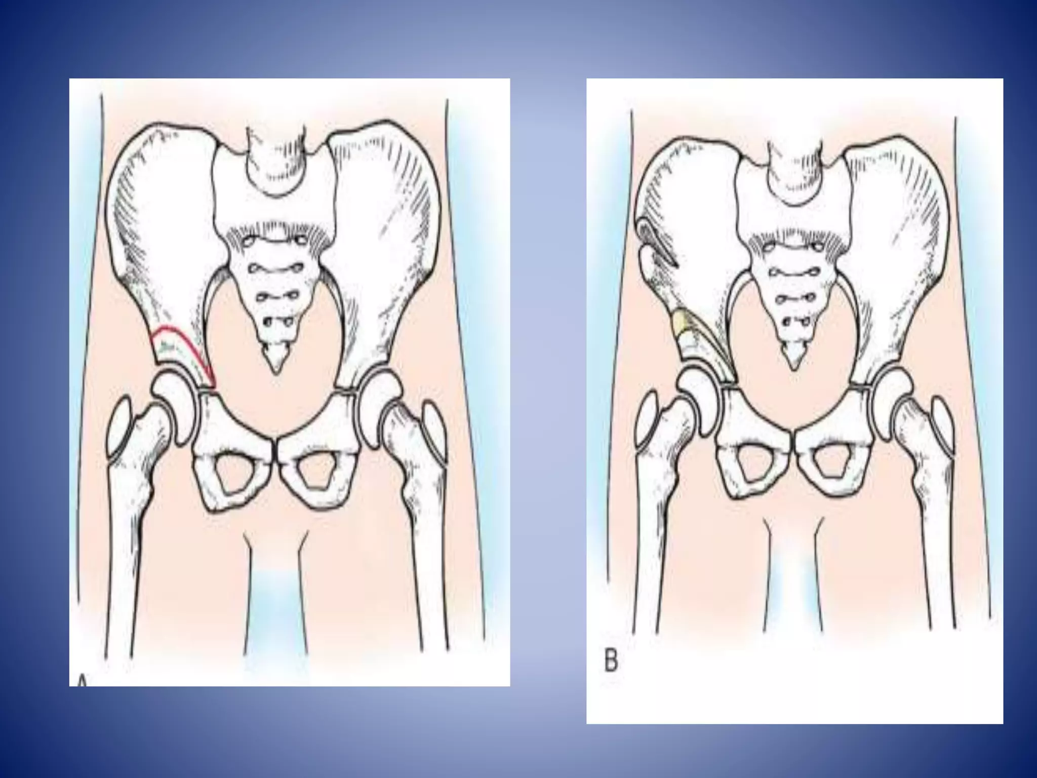 Osteotomies around the hip | PPTX