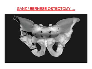 Osteotomies around the hip | PPTX