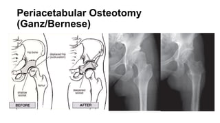 OSTEOTOMIES AROUND THE HIP (Acetabular and Proximal Femur).pptx