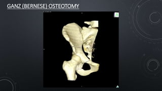 Osteotomies around the hip in DDH | PPTX