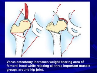 Varus Rotation Osteotomy Osteotomies around the hip joint | PPT