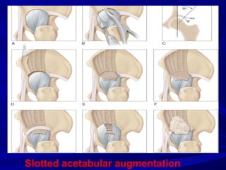 Osteotomies around the hip joint | PPT