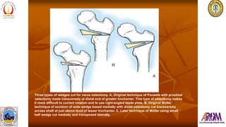 Varus Rotation Osteotomy Osteotomies Without C Arm Tips and Tricks. | PPTX