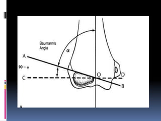 Trautsmann Triangle Osteotomy | PPTX