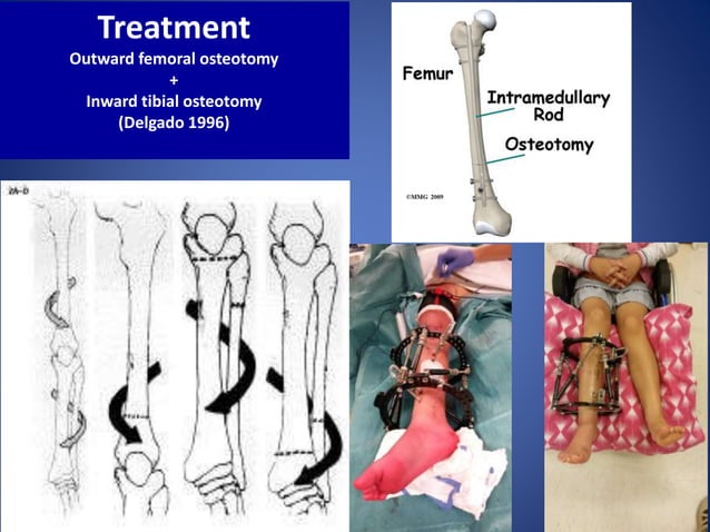 Osteotomy around the knee in children.when and why? | PPTX | Death ...