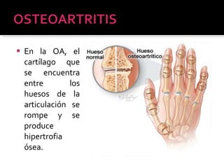 En la OA, el cartílago que se encuentra entre los huesos de la articulación se rompe y se produce hipertrofia ósea. 