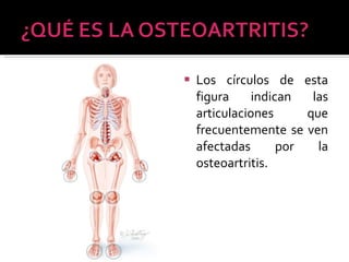 Los círculos de esta figura indican las articulaciones que frecuentemente se ven afectadas por la osteoartritis. 