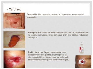 • Tardías:
Dermatitis: Recomendar cambio de dispositivo a un material
adecuado.
Prolapso: Recomendar reducción manual, uso de dispositivo que
no lesione la mucosa, lavar con agua o SF frío, posible reducción
quirúrgica.
Piel irritada por fugas constantes: usar
dispositivo de dos piezas, dejar reposar la
piel, uso de hidrocoloides para sanar la piel y
sellado correcto con pasta para evitar fugas.
 