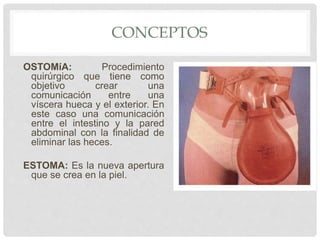 CONCEPTOS
OSTOMíA: Procedimiento
quirúrgico que tiene como
objetivo crear una
comunicación entre una
víscera hueca y el exterior. En
este caso una comunicación
entre el intestino y la pared
abdominal con la finalidad de
eliminar las heces.
ESTOMA: Es la nueva apertura
que se crea en la piel.
 