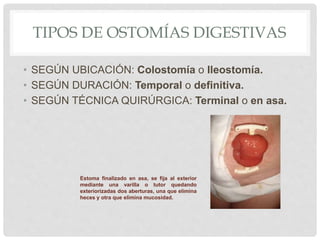 TIPOS DE OSTOMÍAS DIGESTIVAS
• SEGÚN UBICACIÓN: Colostomía o Ileostomía.
• SEGÚN DURACIÓN: Temporal o definitiva.
• SEGÚN TÉCNICA QUIRÚRGICA: Terminal o en asa.
Estoma finalizado en asa, se fija al exterior
mediante una varilla o tutor quedando
exteriorizadas dos aberturas, una que elimina
heces y otra que elimina mucosidad.
 