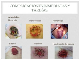 COMPLICACIONES INMEDIATAS Y
TARDÍAS.
• Inmediatas:
Necrosis Dehiscencias Hemorragia
Edema Infección Hundimiento del estoma
 