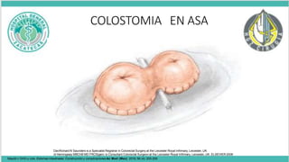 COLOSTOMIA EN ASA
DavRichard N Saunders is a Specialist Registrar in Colorectal Surgery at the Leicester Royal Infirmary,Leicester, UK
id Hemingway MBChB MD FRCS(gen) is Consultant Colorectal Surgeon at the Leicester Royal Infirmary, Leicester, UK. ELSEVIER 2008
Maydó n GHG y cols. Estomas intestinales: Construcción y complicaciones An Med (Mex) 2016; 56 (4): 205-209
 