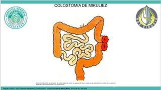 •Paul Mikuliez (cañón de escopeta): Se realiza después de resecar un segmento del colon, uniendo los dos cabos entre sí a nivel de la cara posterior,
quedando un estoma funcionante y una fístula mucosa.
18
COLOSTOMIA DE MIKULIEZ
Maydó n GHG y cols. Estomas intestinales: Construcción y complicaciones An Med (Mex) 2016; 56 (4): 205-209
 