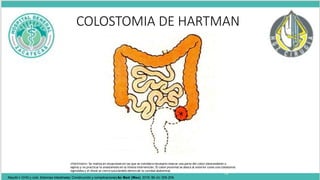 COLOSTOMIA DE HARTMAN
•Hartmann: Se realiza en situaciones en las que se considera necesario resecar una parte del colon (descendente o
sigma) y no practicar la anastomosis en la misma intervención. El colon proximal se aboca al exterior como una colostomía
sigmoidea y el distal se cierra suturándolo dentro de la cavidad abdominal.
19
Maydó n GHG y cols. Estomas intestinales: Construcción y complicaciones An Med (Mex) 2016; 56 (4): 205-209
 