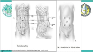 PREPARACION DEL SITIO DE OSTOMIA
Marcaciondel sitio
Discoenpiel 2cmdediametro
Insicion
Separacionlongitudinal fibrasmusculares
Clampintestinal
Cierredeparedabdominal
Sangradodel estoma
Maduracion8puntos
Principles and Practice of Surgery for the Colon, Rectum and Anus, Third Edition
Maydó n GHG y cols. Estomas intestinales: Construcción y complicaciones An Med (Mex) 2016; 56 (4): 205-
209
 