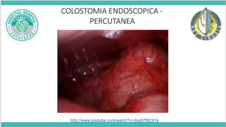 COLOSTOMIA ENDOSCOPICA -
PERCUTANEA
http://www.youtube.com/watch?v=dvg87t6C91k
 