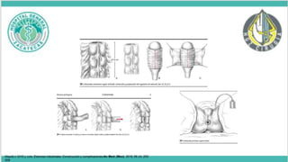 SCHMIDT
© 2002, Editions Scientifiques et Médicales Elsevier SAS, París. Todos los derechos reservados.
Maydó n GHG y cols. Estomas intestinales: Construcción y complicaciones An Med (Mex) 2016; 56 (4): 205-
209
 