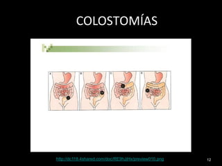12
COLOSTOMÍAS
http://dc118.4shared.com/doc/RE9hJjHx/preview010.png
 