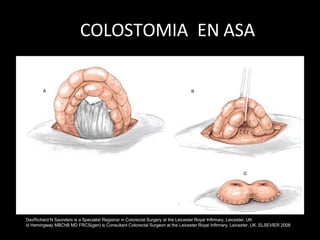 COLOSTOMIA EN ASA
DavRichard N Saunders is a Specialist Registrar in Colorectal Surgery at the Leicester Royal Infirmary, Leicester, UK
id Hemingway MBChB MD FRCS(gen) is Consultant Colorectal Surgeon at the Leicester Royal Infirmary, Leicester, UK. ELSEVIER 2008
 