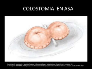 COLOSTOMIA EN ASA
DavRichard N Saunders is a Specialist Registrar in Colorectal Surgery at the Leicester Royal Infirmary, Leicester, UK
id Hemingway MBChB MD FRCS(gen) is Consultant Colorectal Surgeon at the Leicester Royal Infirmary, Leicester, UK. ELSEVIER 2008
 
