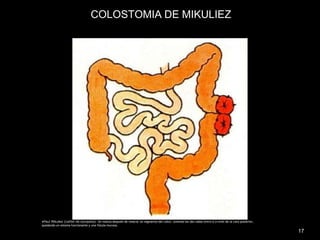 •Paul Mikuliez (cañón de escopeta): Se realiza después de resecar un segmento del colon, uniendo los dos cabos entre sí a nivel de la cara posterior,
quedando un estoma funcionante y una fístula mucosa.
17
COLOSTOMIA DE MIKULIEZ
 
