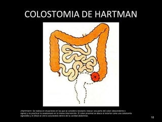 COLOSTOMIA DE HARTMAN
•Hartmann: Se realiza en situaciones en las que se considera necesario resecar una parte del colon (descendente o
sigma) y no practicar la anastomosis en la misma intervención. El colon proximal se aboca al exterior como una colostomía
sigmoidea y el distal se cierra suturándolo dentro de la cavidad abdominal.
18
 