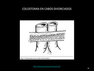 20
COLOSTOMIA EN CABOS DIVORCIADOS
http://www.sacd.org.ar/tnueve.pdf
 