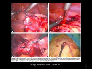 Urology Journal Vol 8 No 1 Winter 2011
23
 