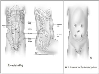 PREPARACION DEL SITIO DE OSTOMIA
Marcaciondel sitio
Discoenpiel 2cmdediametro
Insicion
Separacionlongitudinal fibrasmusculares
Clampintestinal
Cierredeparedabdominal
Sangradodel estoma
Maduracion8puntos
Principles and Practice of Surgery for the Colon, Rectum and Anus, Third Edition
 