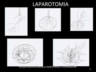 27
Maingot's Abdominal Operations ZINNER-ASHLEY 11ed McGraw-Hill
LAPAROTOMIA
 