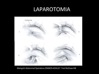 LAPAROTOMIA
Maingot's Abdominal Operations ZINNER-ASHLEY 11ed McGraw-Hill
 