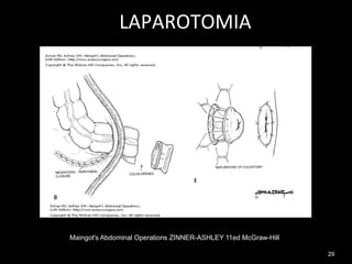 LAPAROTOMIA
29
Maingot's Abdominal Operations ZINNER-ASHLEY 11ed McGraw-Hill
 