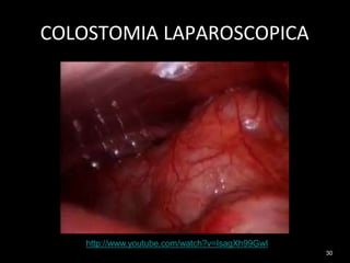 COLOSTOMIA LAPAROSCOPICA
http://www.youtube.com/watch?v=IsagXh99GwI
30
 