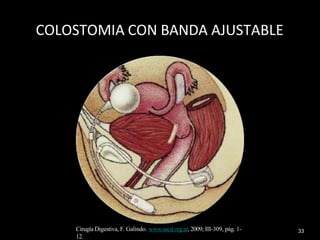 33
COLOSTOMIA CON BANDA AJUSTABLE
Cirugía Digestiva, F. Galindo. www.sacd.org.ar, 2009; III-309, pág. 1-
12.
 