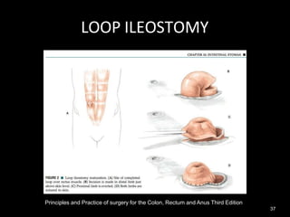 LOOP ILEOSTOMY
Principles and Practice of surgery for the Colon, Rectum and Anus Third Edition
37
 